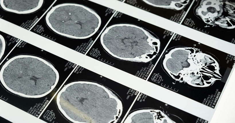 Análisis comparativo de la evaluación visual, la escala centiloide y el seguimiento clínico en pacientes con sospecha de enfermedad de Alzheimer mediante la PET con [18F]Florbetaben